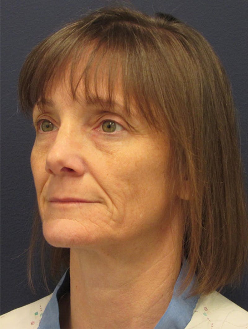 Facial Fat Graft Before & After Gallery - Patient 174146441 - Image 5