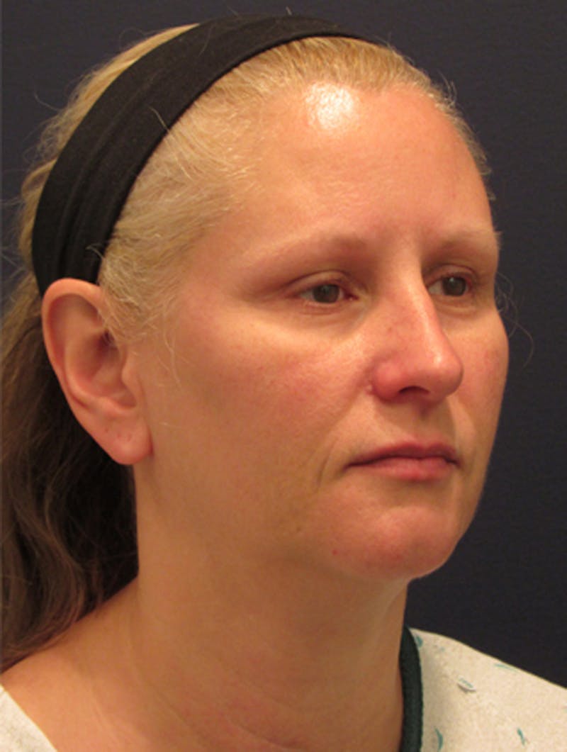 Facial Fat Graft Before & After Gallery - Patient 174146444 - Image 3