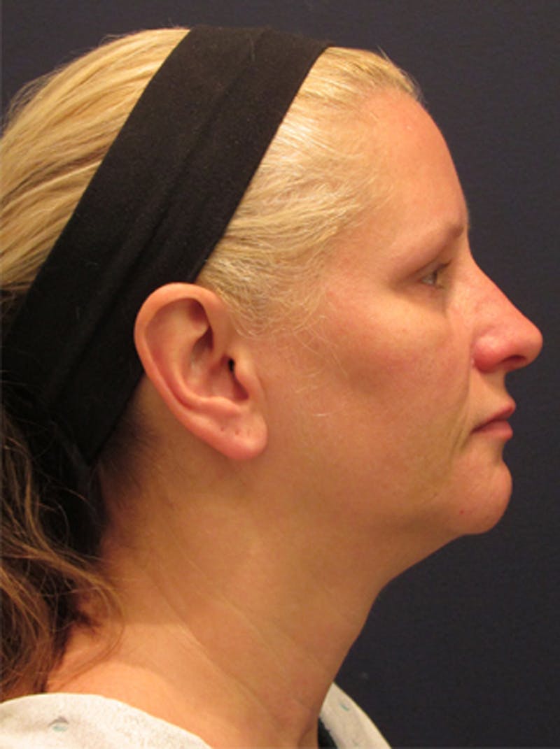 Facial Fat Graft Before & After Gallery - Patient 174146444 - Image 5