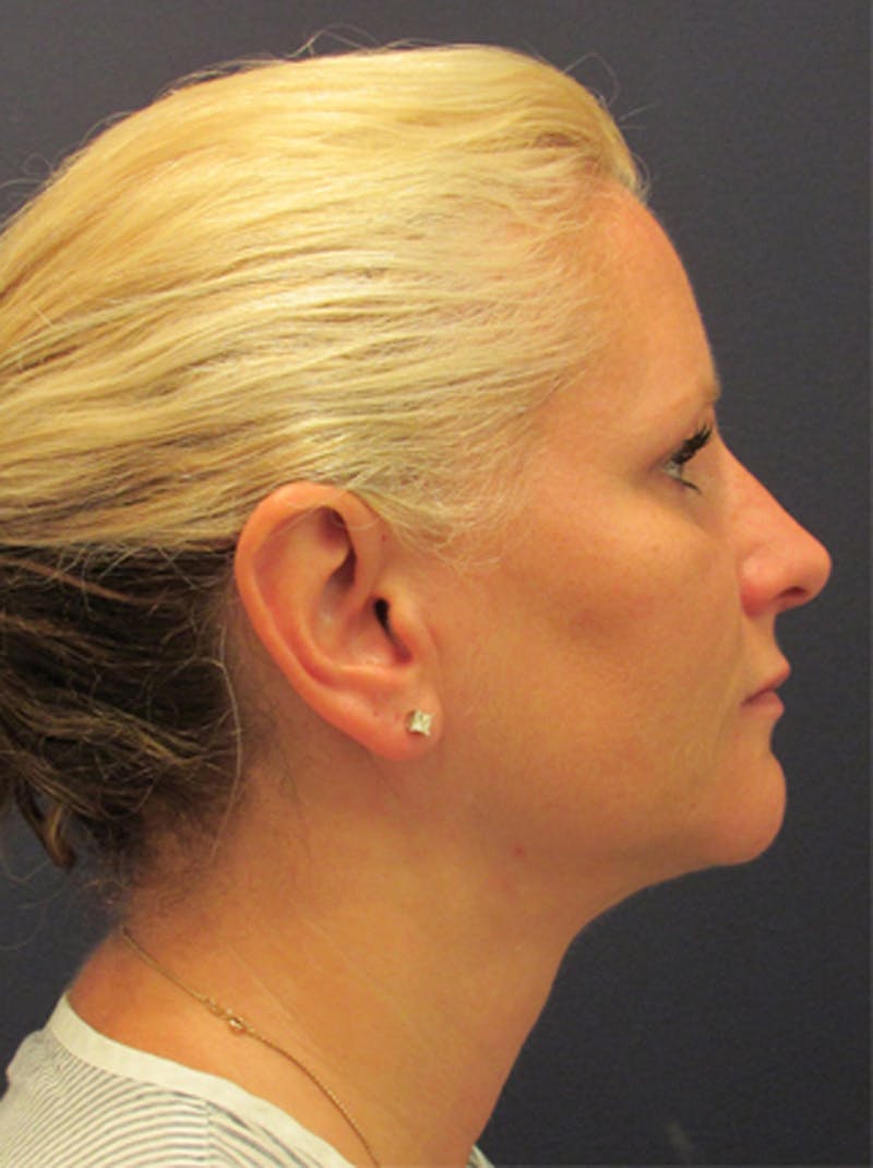 Facial Fat Graft Before & After Gallery - Patient 174146444 - Image 6