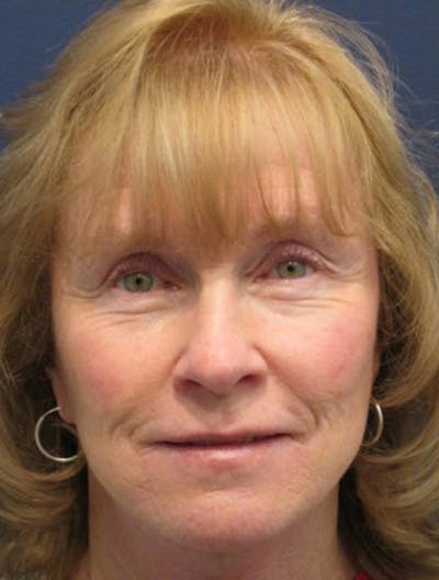 Facial Fat Graft Before & After Gallery - Patient 174146448 - Image 2