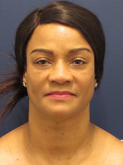 Facial Fat Graft Before & After Gallery - Patient 174146455 - Image 1