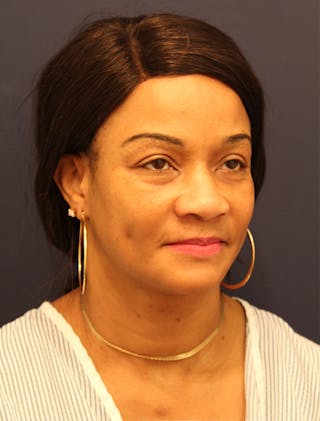 Facial Fat Graft Before & After Gallery - Patient 174146455 - Image 4