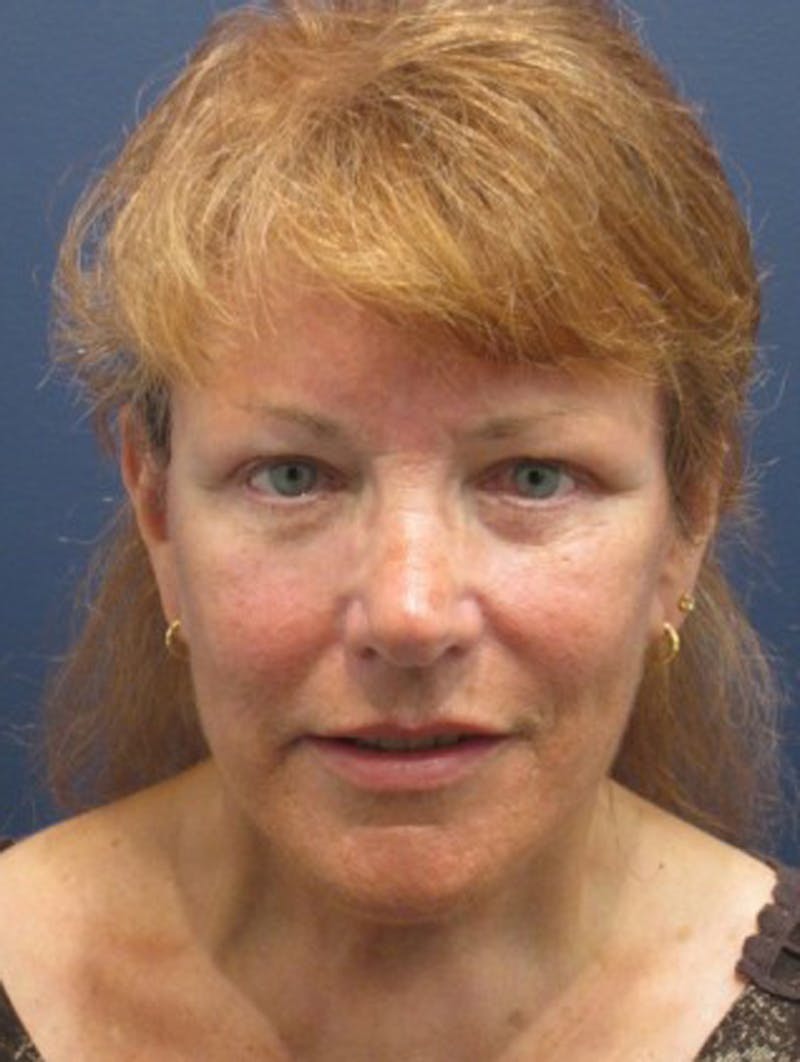 Facial Fat Graft Before & After Gallery - Patient 174146464 - Image 2