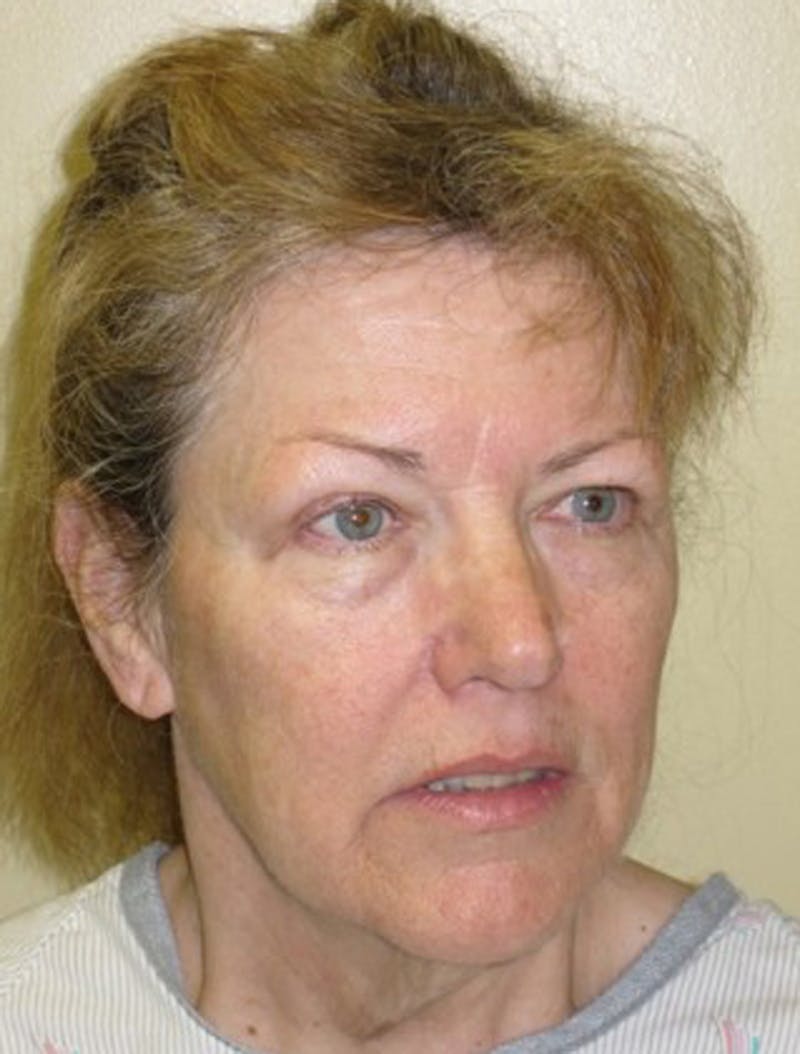Facial Fat Graft Before & After Gallery - Patient 174146464 - Image 3