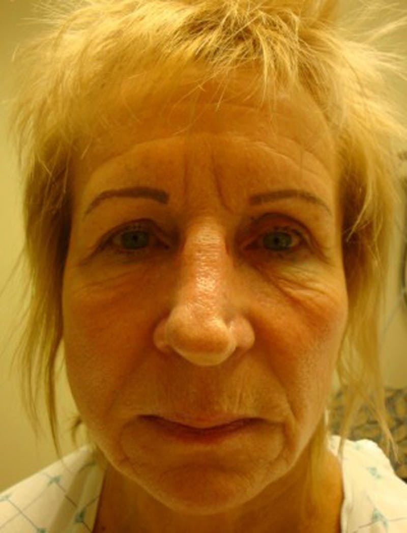 Facial Fat Graft Before & After Gallery - Patient 174146468 - Image 1