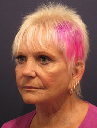 Facial Fat Graft Before & After Gallery - Patient 174146473 - Image 4