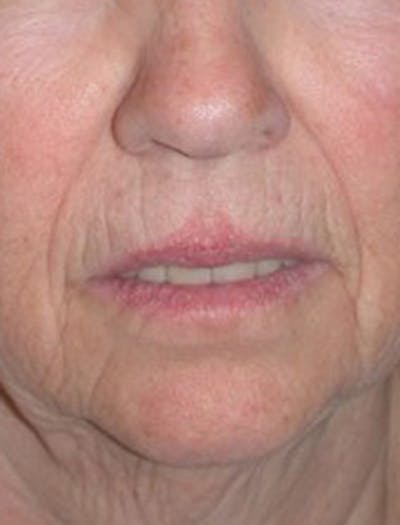 Facial Fat Graft Before & After Gallery - Patient 174146482 - Image 1
