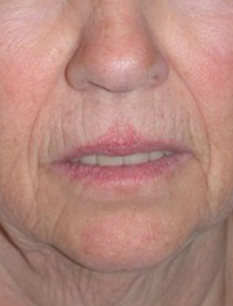 Facial Fat Graft Before & After Gallery - Patient 174146482 - Image 1