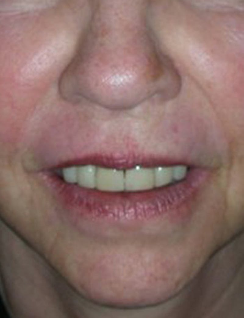 Facial Fat Graft Before & After Gallery - Patient 174146482 - Image 2