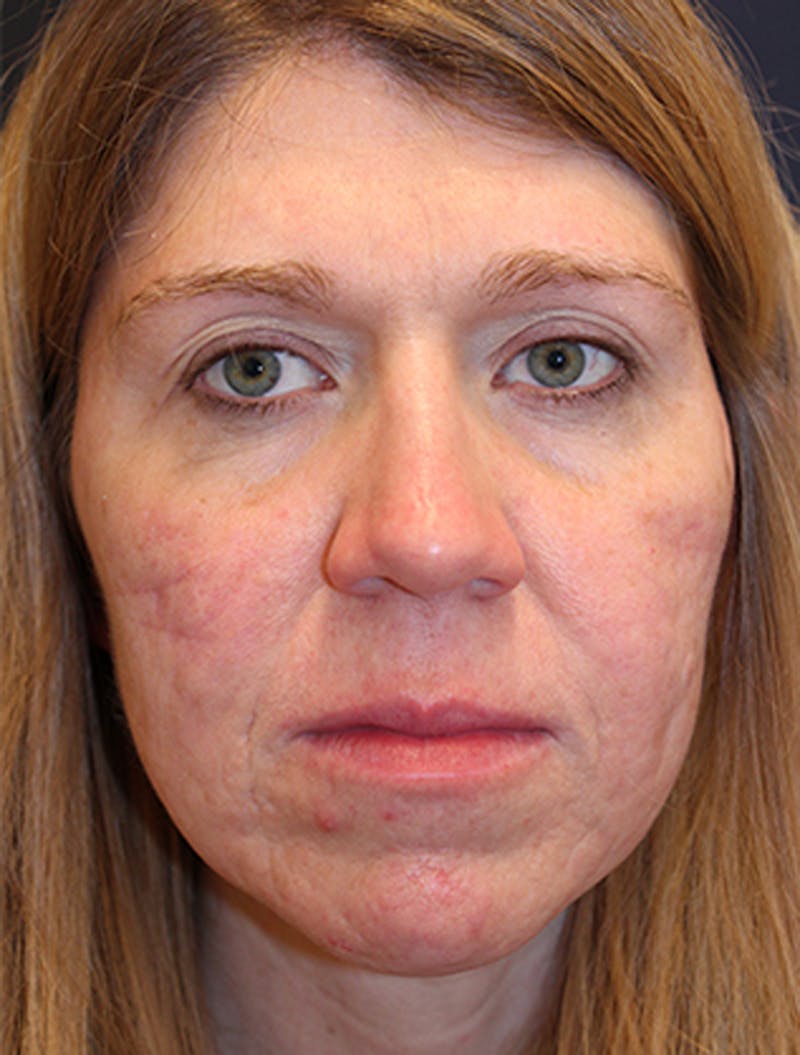Facial Fat Graft Before & After Gallery - Patient 174146487 - Image 1