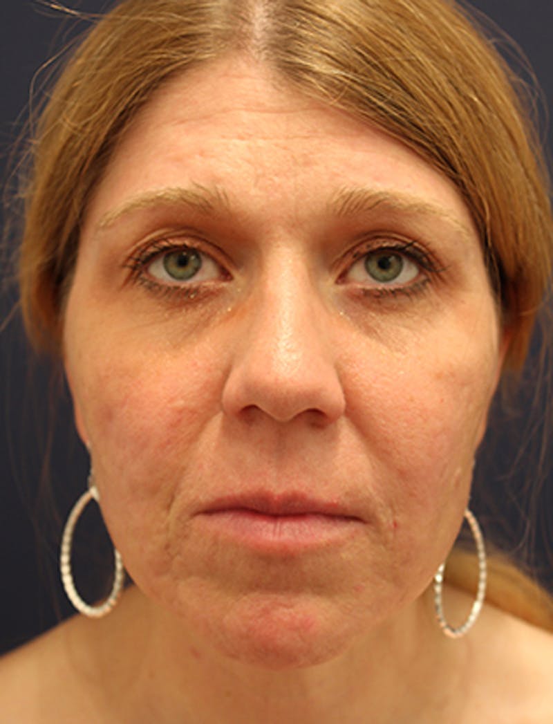 Facial Fat Graft Before & After Gallery - Patient 174146487 - Image 2
