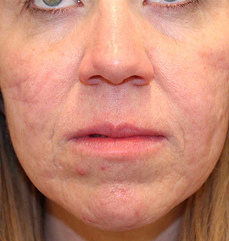 Facial Fat Graft Before & After Gallery - Patient 174146487 - Image 3