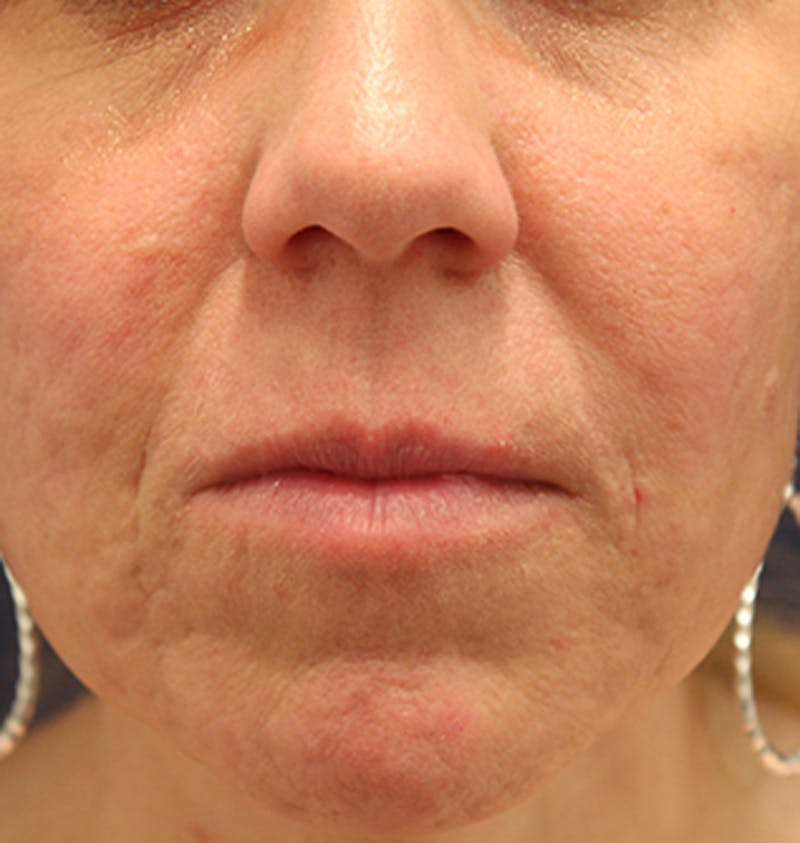 Facial Fat Graft Before & After Gallery - Patient 174146487 - Image 4