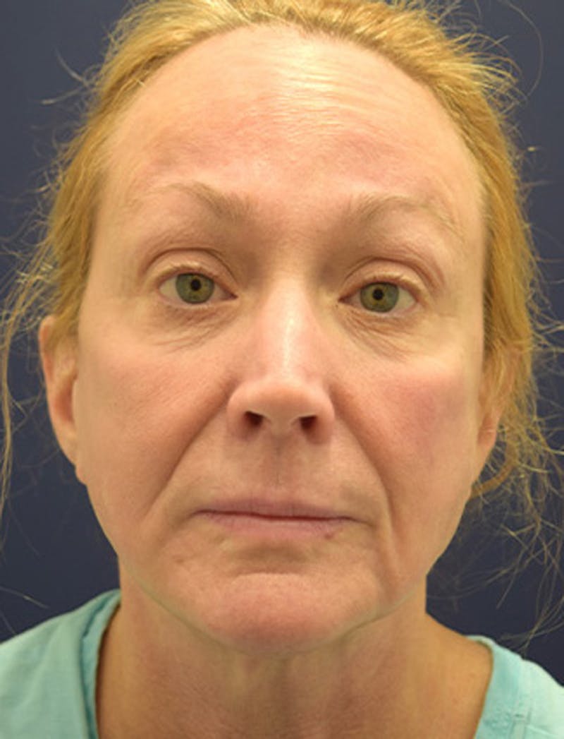 Facial Fat Graft Before & After Gallery - Patient 174146493 - Image 1