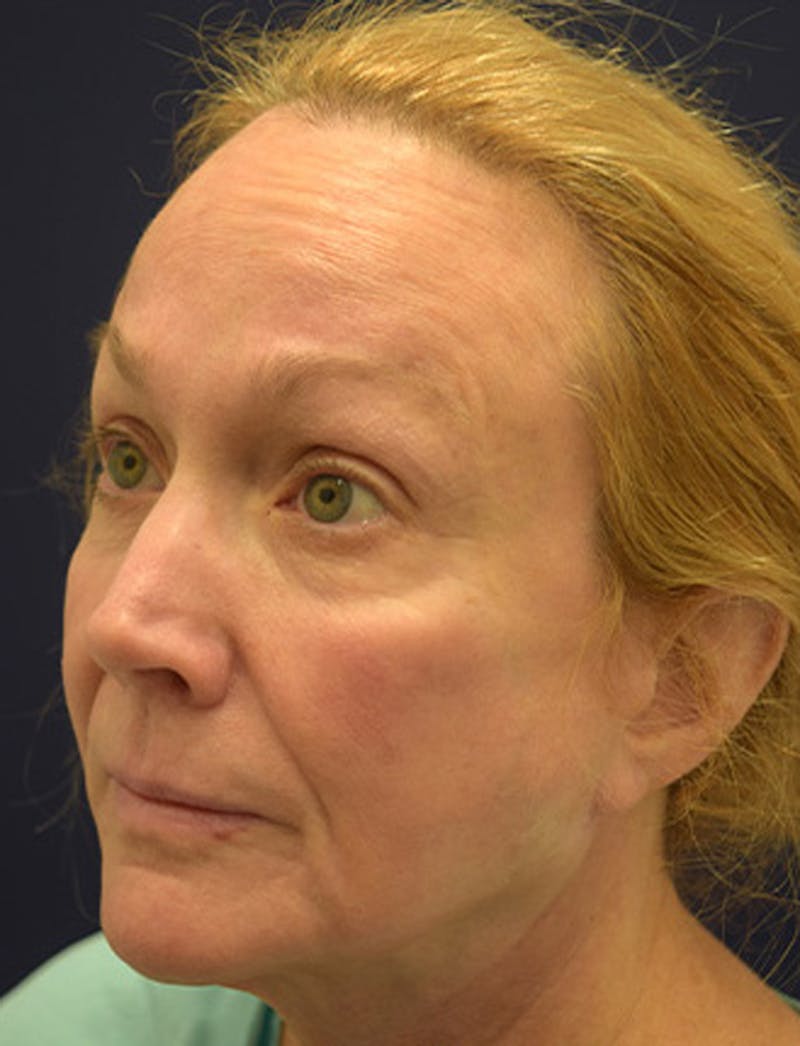Facial Fat Graft Before & After Gallery - Patient 174146493 - Image 3