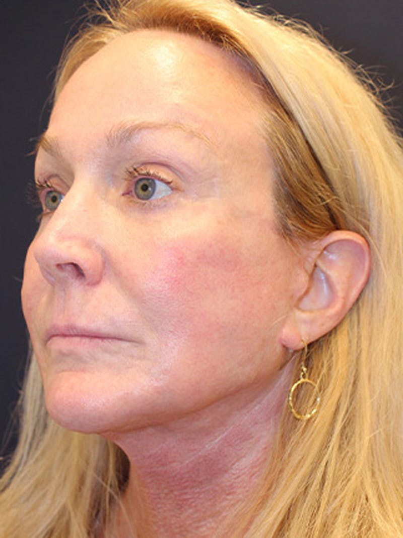 Facial Fat Graft Before & After Gallery - Patient 174146493 - Image 4