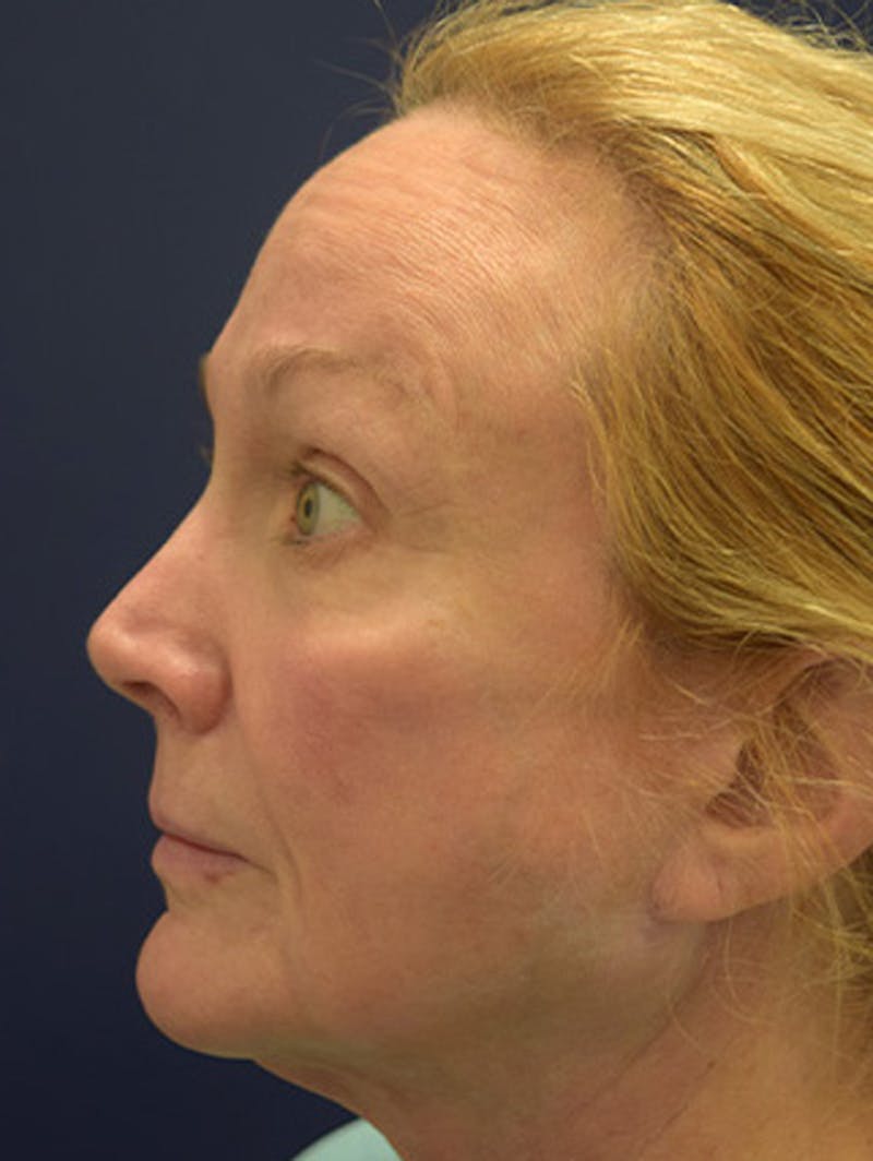 Facial Fat Graft Before & After Gallery - Patient 174146493 - Image 5