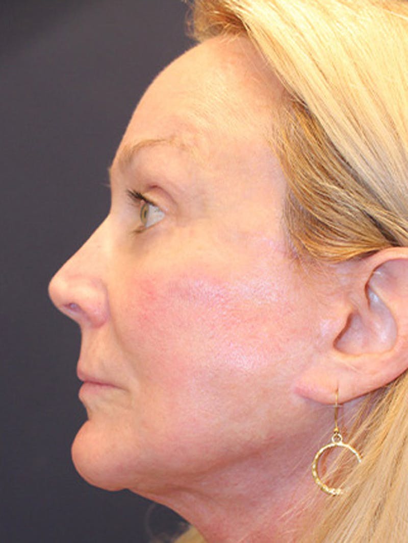 Facial Fat Graft Before & After Gallery - Patient 174146493 - Image 6