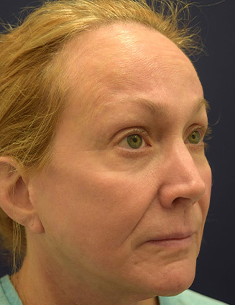 Facial Fat Graft Before & After Gallery - Patient 174146493 - Image 7