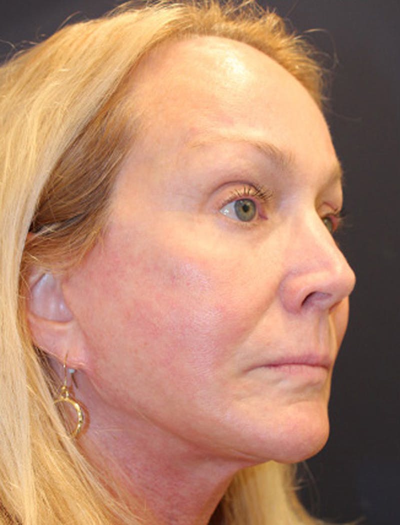 Facial Fat Graft Before & After Gallery - Patient 174146493 - Image 8
