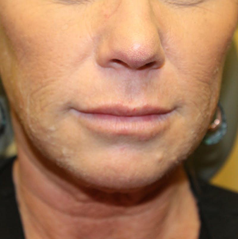 Injectables Before & After Gallery - Patient 174146451 - Image 1
