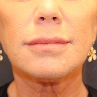 Injectables Before & After Gallery - Patient 174146451 - Image 2