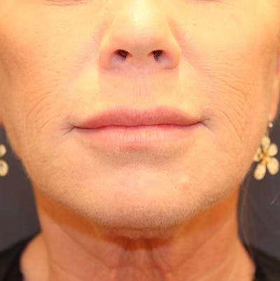 Injectables Before & After Gallery - Patient 174146451 - Image 2