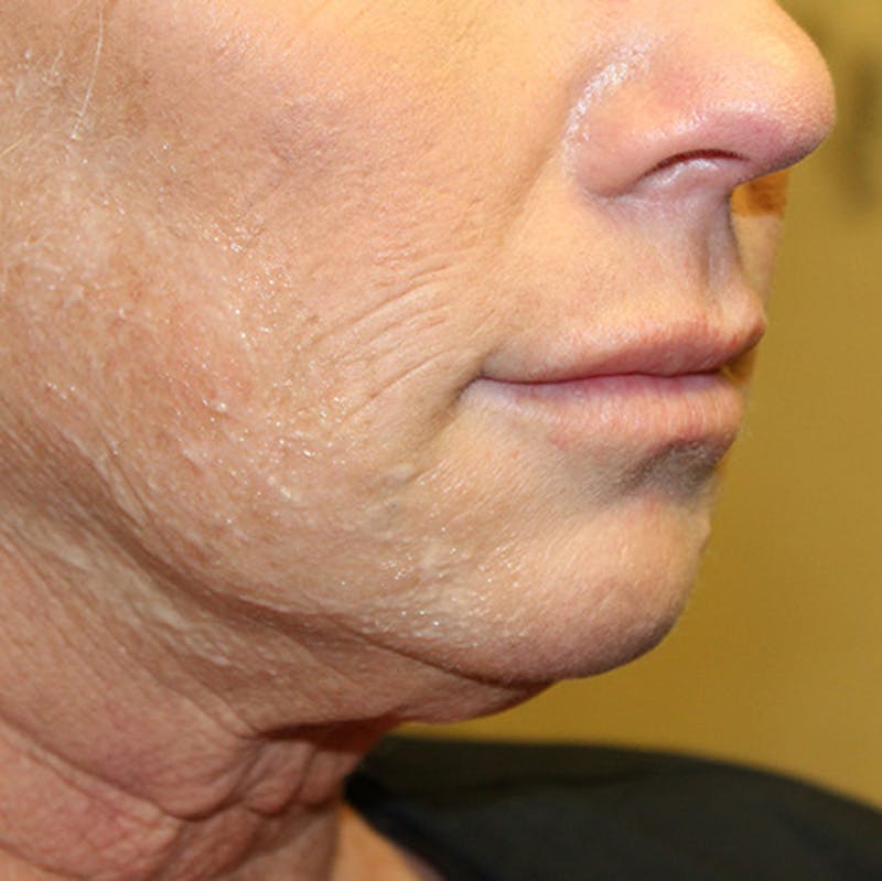 Injectables Before & After Gallery - Patient 174146451 - Image 3