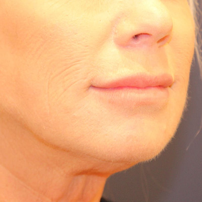 Injectables Before & After Gallery - Patient 174146451 - Image 4