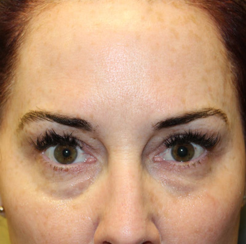 Injectables Before & After Gallery - Patient 174146454 - Image 1