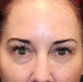 Injectables Before & After Gallery - Patient 174146454 - Image 2