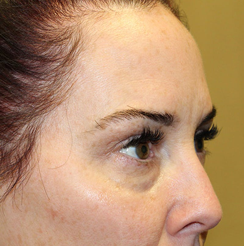 Injectables Before & After Gallery - Patient 174146454 - Image 3