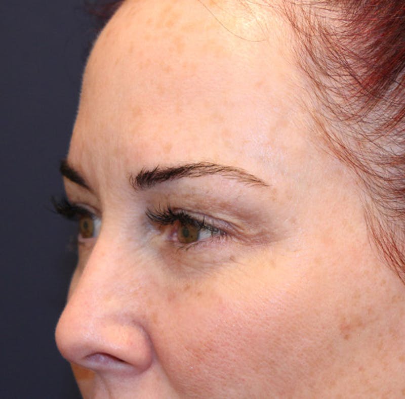Injectables Before & After Gallery - Patient 174146454 - Image 6