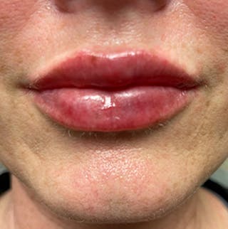 Injectables Before & After Gallery - Patient 174146458 - Image 2