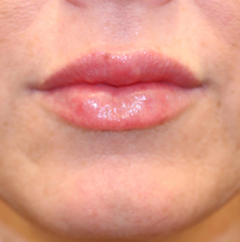 Injectables Before & After Gallery - Patient 174146458 - Image 4