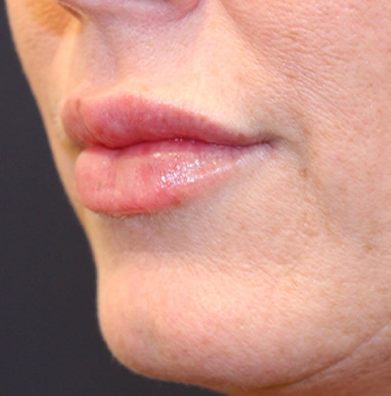 Injectables Before & After Gallery - Patient 174146458 - Image 8