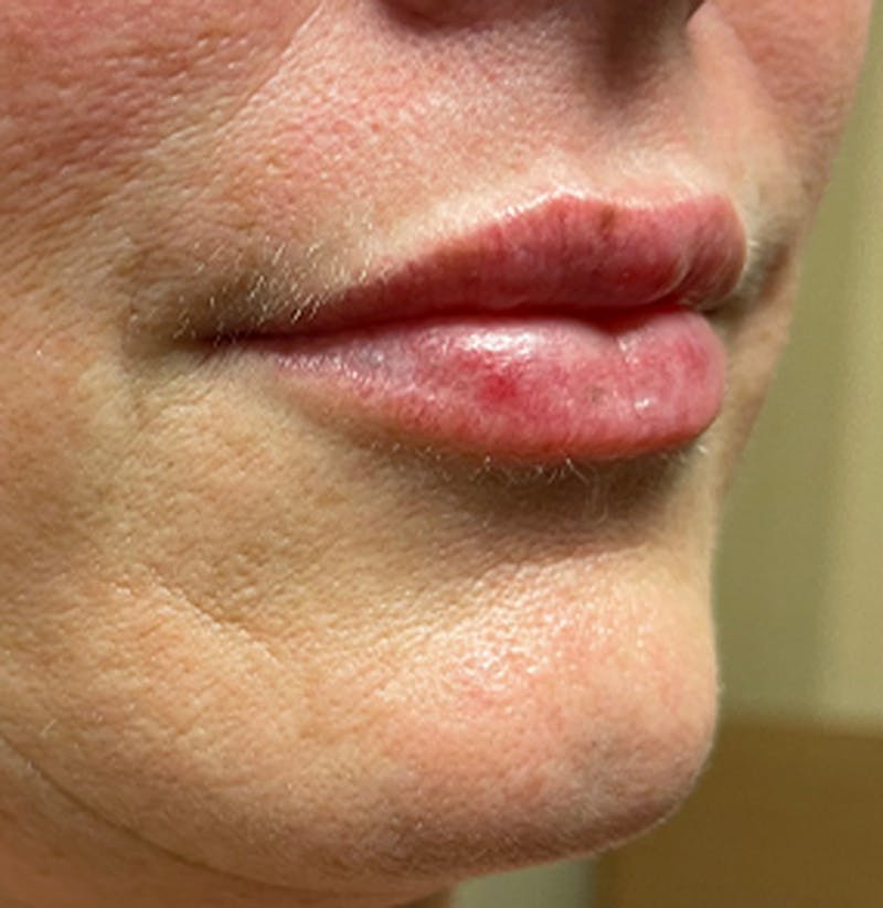 Injectables Before & After Gallery - Patient 174146458 - Image 9