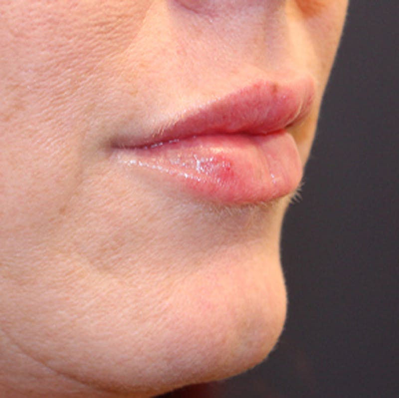 Injectables Before & After Gallery - Patient 174146458 - Image 10
