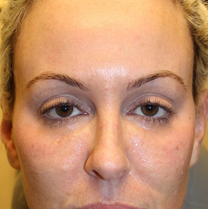 Injectables Before & After Gallery - Patient 174146463 - Image 1