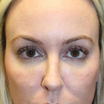 Injectables Before & After Gallery - Patient 174146463 - Image 2