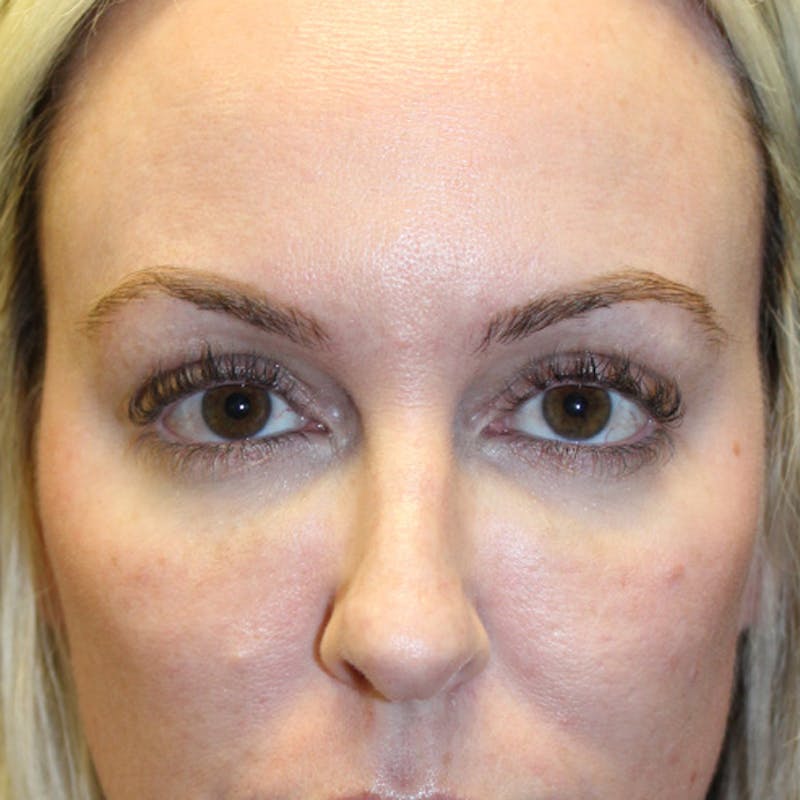 Injectables Before & After Gallery - Patient 174146463 - Image 2