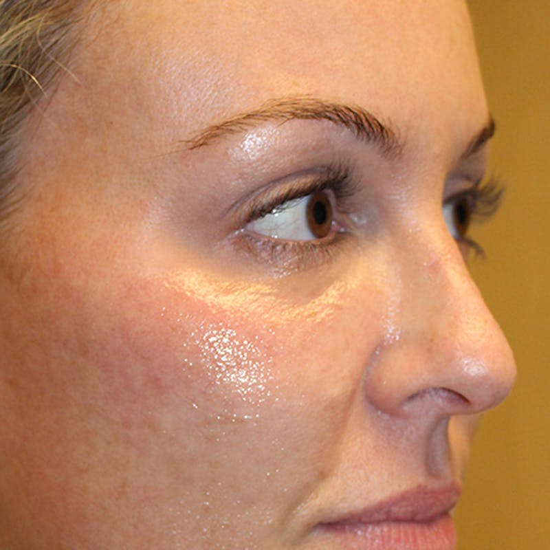 Injectables Before & After Gallery - Patient 174146463 - Image 3