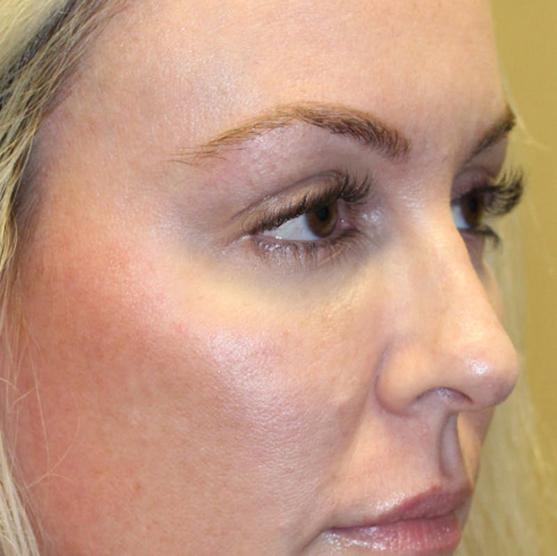 Injectables Before & After Gallery - Patient 174146463 - Image 4