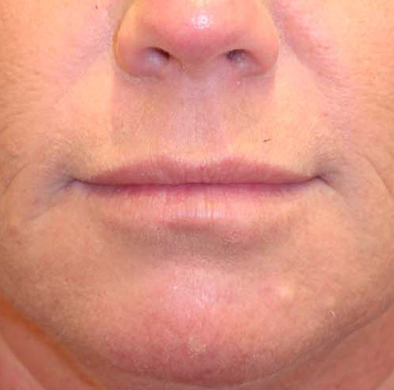 Injectables Before & After Gallery - Patient 174146472 - Image 1
