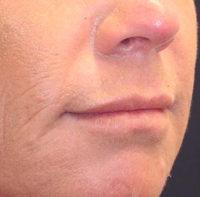 Injectables Before & After Gallery - Patient 174146472 - Image 3