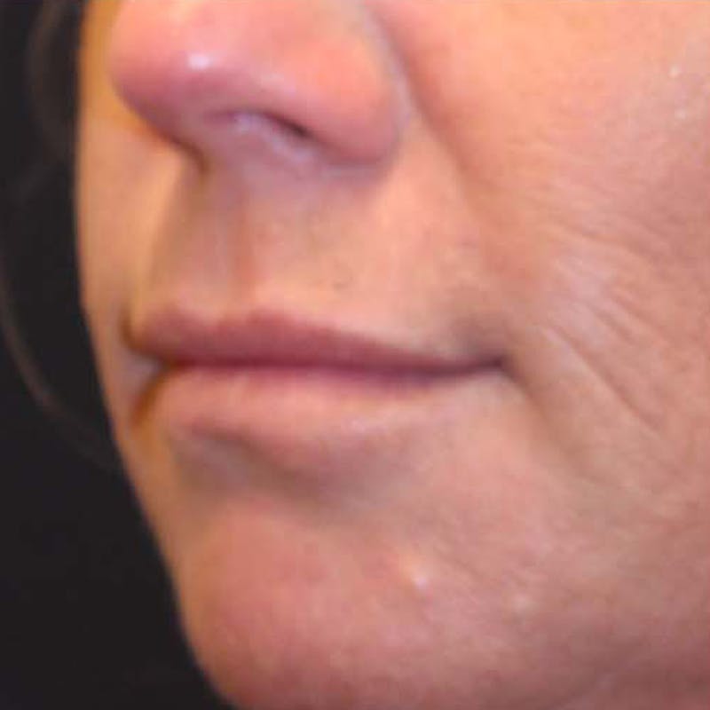 Injectables Before & After Gallery - Patient 174146472 - Image 5