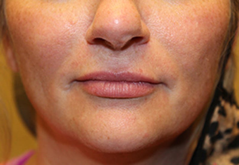 Injectables Before & After Gallery - Patient 174146486 - Image 1