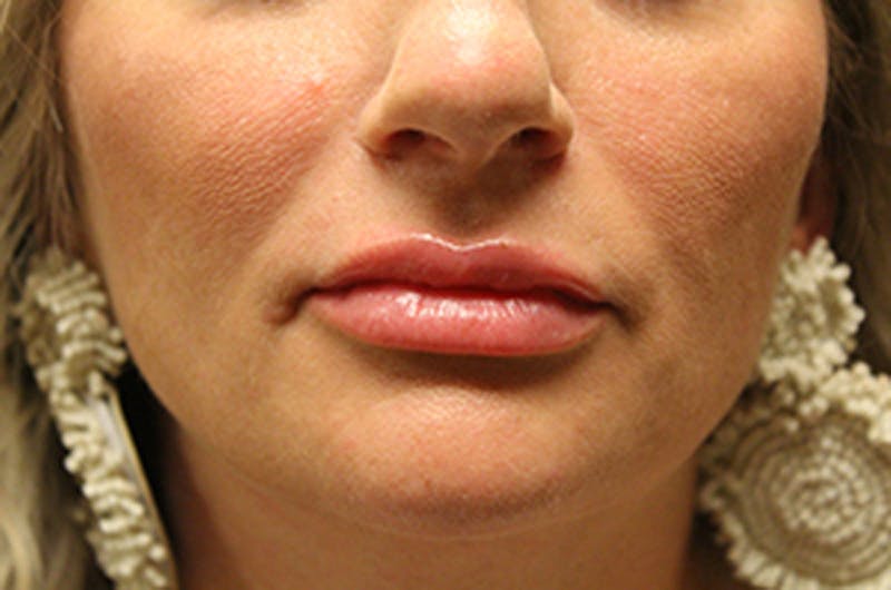 Injectables Before & After Gallery - Patient 174146486 - Image 2