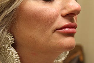 Injectables Before & After Gallery - Patient 174146486 - Image 4